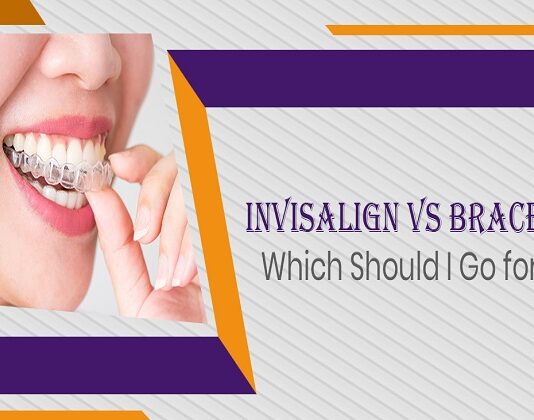 Invisalign Vs. Braces: Which Should I Go for? Invisalign-Vs-Braces