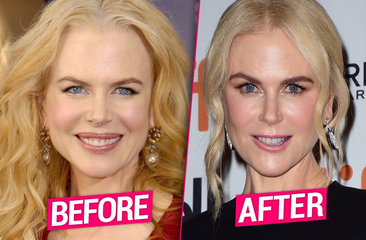 But, Dr.Rowe thinks that Kidman had a facelift.