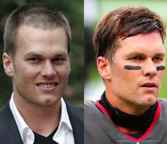 Tom Brady Plastic Surgery Is Tom Bardy plastic surgery