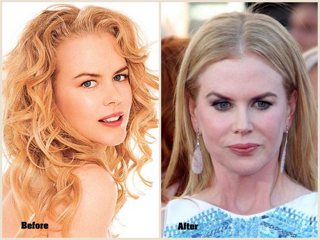 Nicole Kidman Plastic Surgery: Fans' Reaction