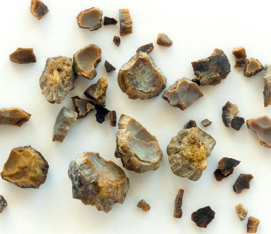 The Best Ways to Get Rid of Bladder Stones The Best Ways to Get Rid of Bladder Stones