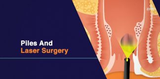 Is the Laser Treatment for Hemorrhoids Effective?