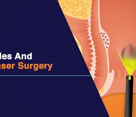 Is the Laser Treatment for Hemorrhoids Effective?
