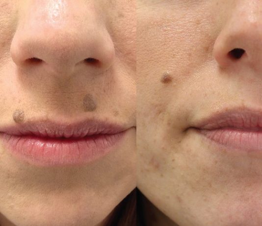 Mole removal cost Mole removal cost