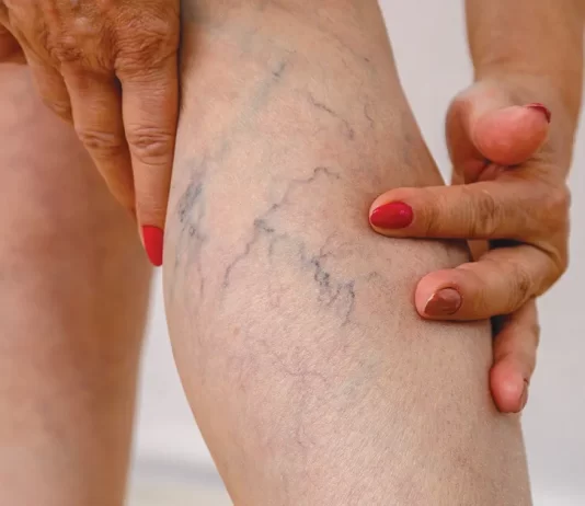 What to Expect During and After Vein Treatment in Houston